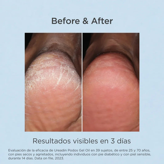 ISDIN Ureadin Podos Gel Oil 75ml | ISDIN | AbsoluteSkin