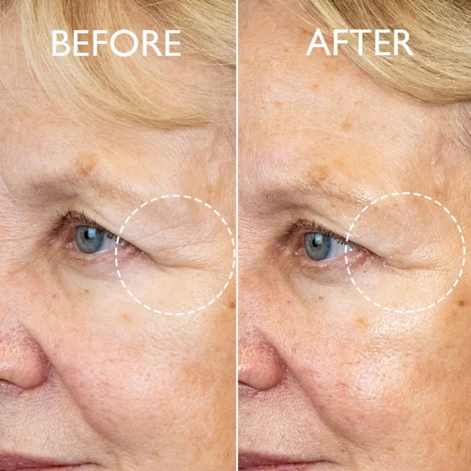 A close-up before-and-after comparison of a woman's eye area, showing wrinkles around the eye in the left 'BEFORE' panel and reduced wrinkles in the right 'AFTER' panel, with white dashed circles highlighting the treated area.