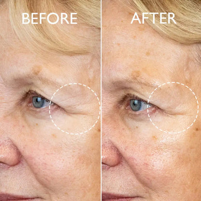 A close-up before-and-after comparison of a woman's eye area, showing wrinkles around the eye in the left 'BEFORE' panel and reduced wrinkles in the right 'AFTER' panel, with white dashed circles highlighting the treated area.